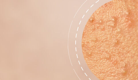 A close-up view of textured skin, highlighting small bumps and imperfections against a soft, blurred background.