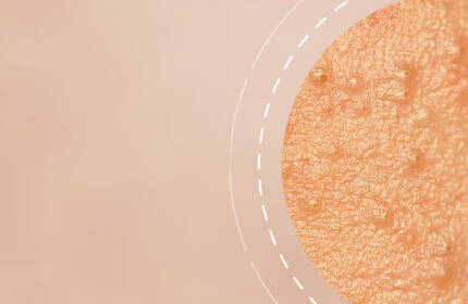 A close-up view of textured skin, highlighting small bumps and imperfections against a soft, blurred background.