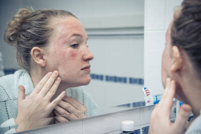 Pelle Arrossata a Tendenza Acneica Skinceuticals