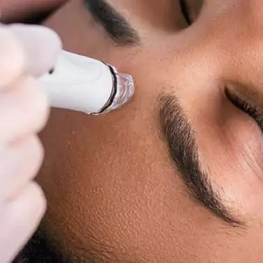 LIP FILLER