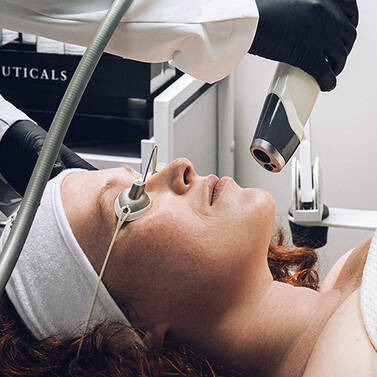 LE MICRONEEDLING